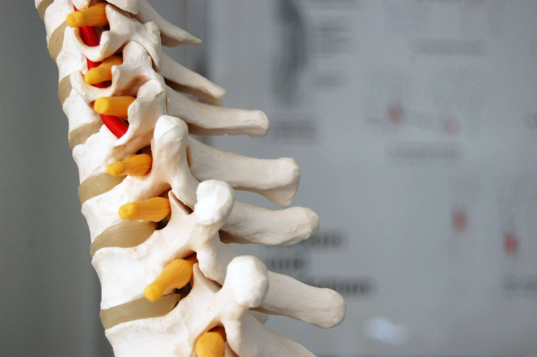 Spine model showing compressed nerve treated by a pinched nerve chiropractor in Vero Beach